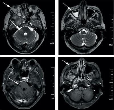 Frontiers Rhino Orbital Cerebral Mucormycosis In A Patient With